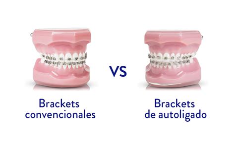 diferencia entre bracketes y autoligados